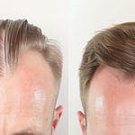 Hair-Implants-For-Men-Procedure-Results-Costs-Recovery-360x180