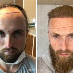 before-after-hair-transplant-fue-sapphire-3700-grafts-frederik-g
