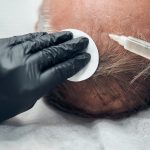 Close up of cosmetologist in sterile gloves making injection in male head while performing hair loss treatment